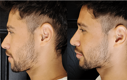 Nose Filler -Mens Clinic Only